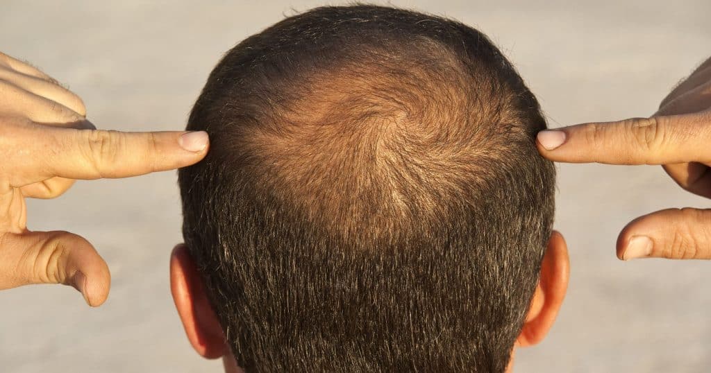 Does Keto Cause Hair Loss Science Iron does-keto-cause-hair-loss-science-iron